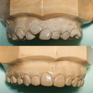 Est-il vrai que les dents s’alignent toutes seules avec la croissance ?