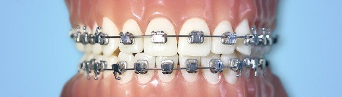Les différents appareillages orthodontiques